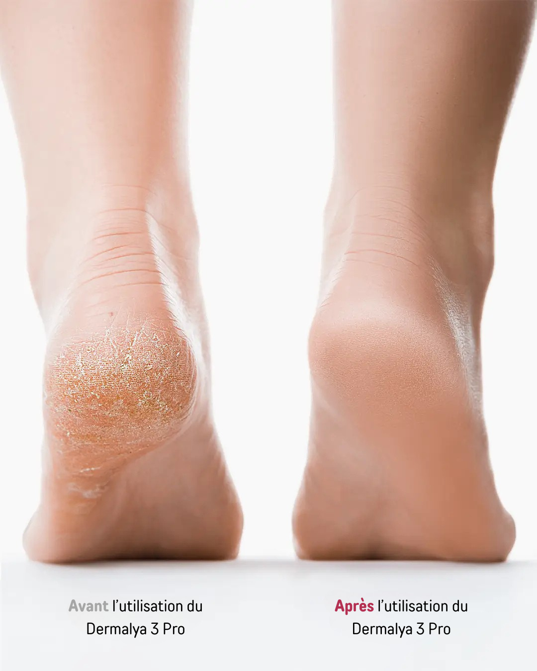 Dermalya 3 pro
